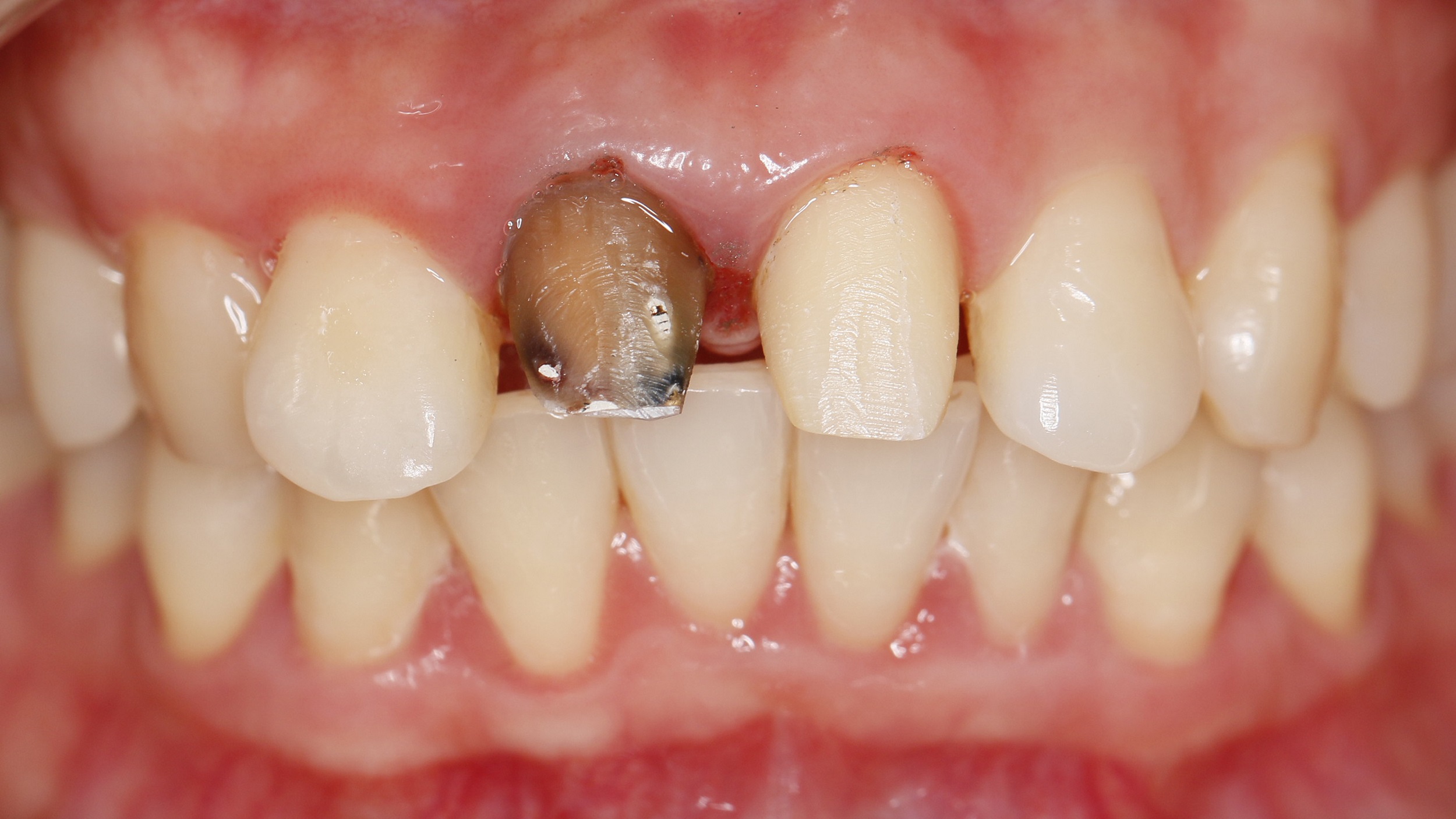 为什么根管治疗后的牙齿需要做牙套？ - 知乎