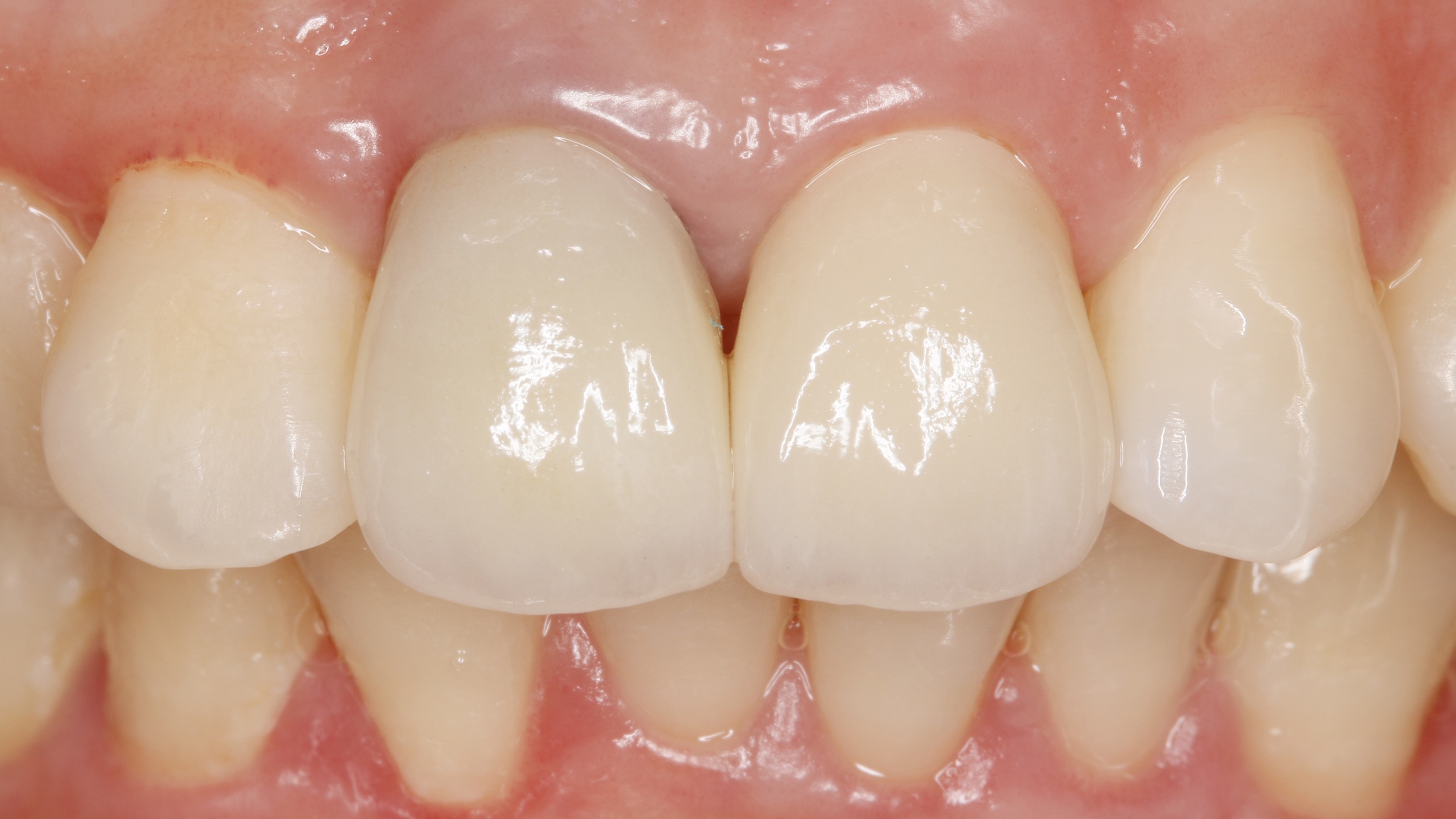 图1-2-3 上颌中切牙-口腔解剖-医学