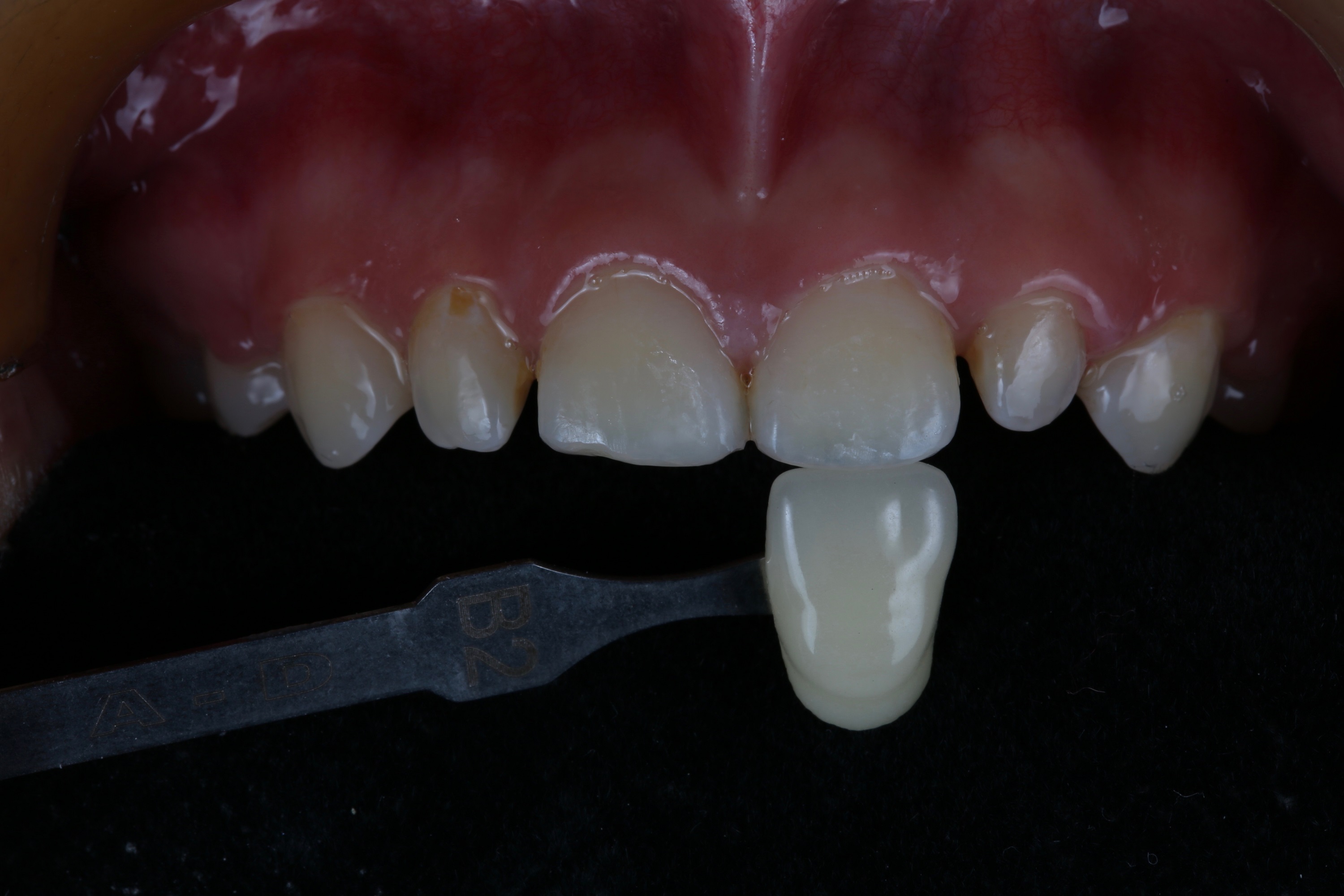 口腔数字化设计在唇腭裂患者前牙美学修复中的应用研究