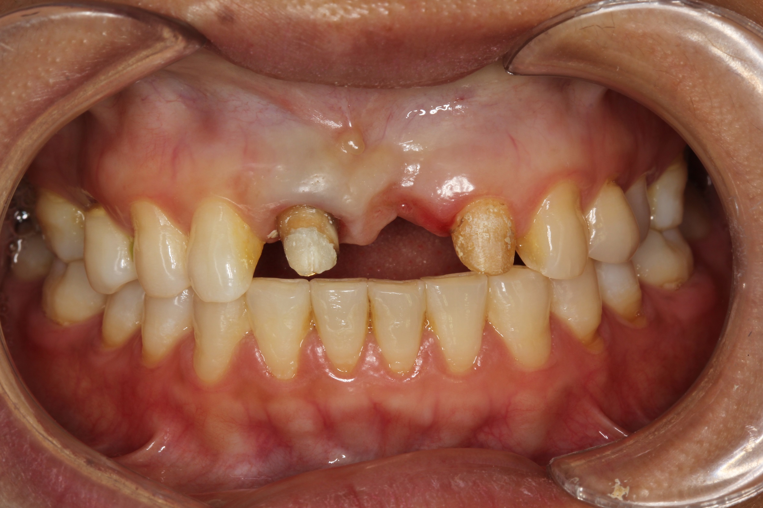 全口牙缺失，活动义齿修复 - 知乎