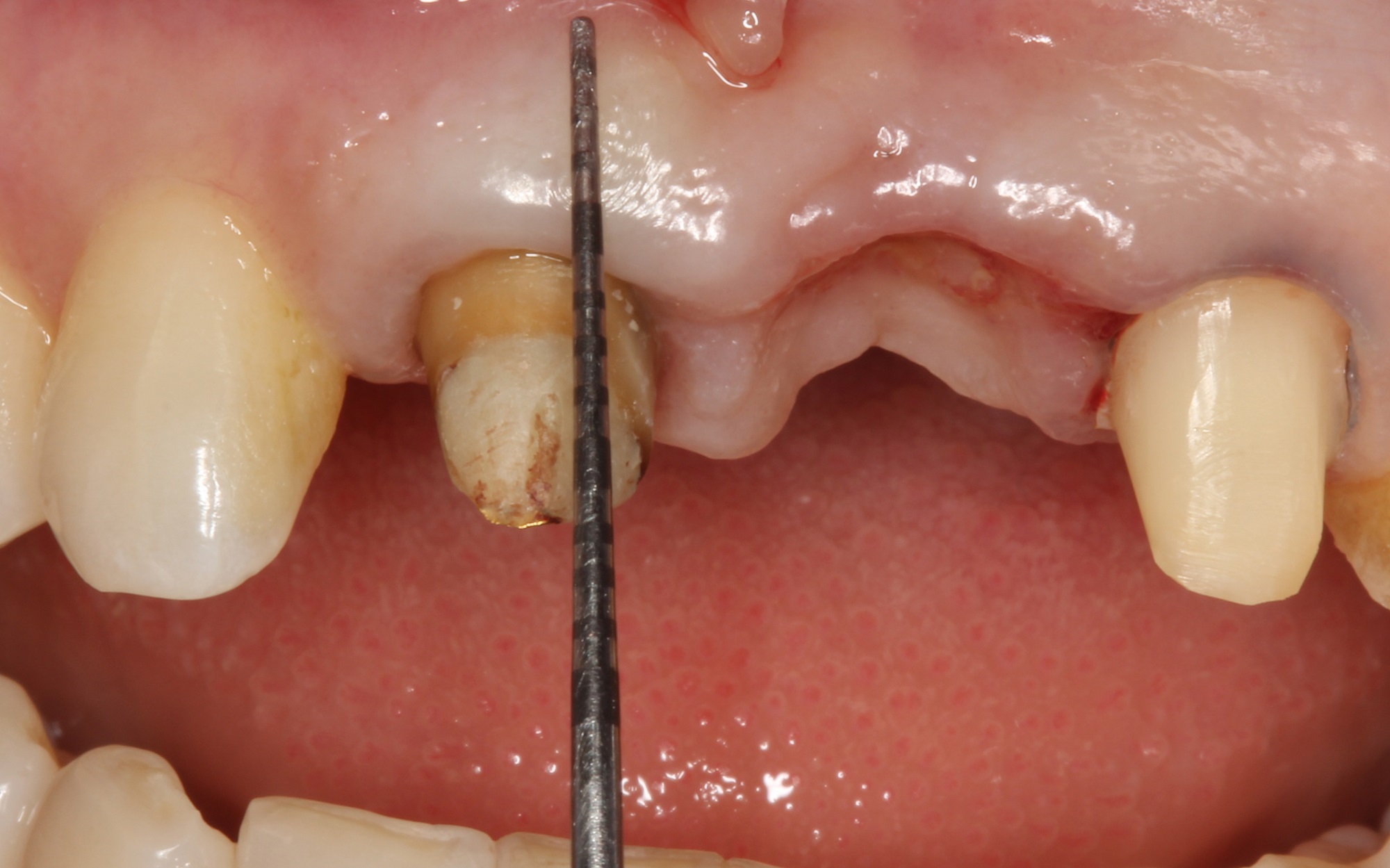 有一种牙齿叫“瓜子牙” - 白齿屋美牙培训进修中心