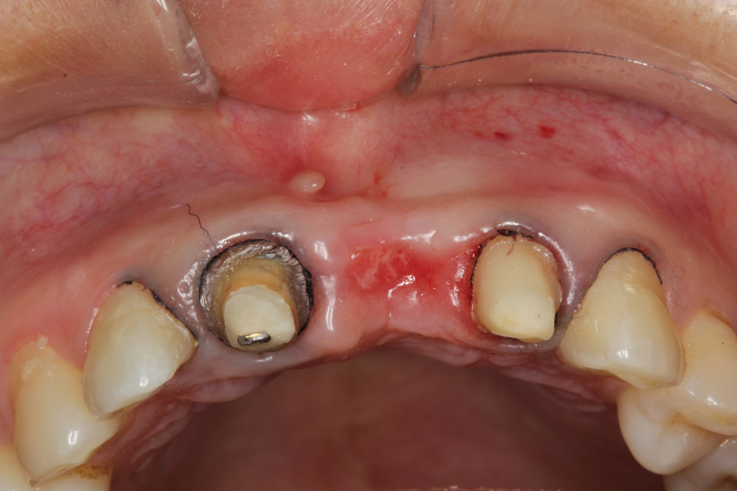 改良隧道技术联合树脂充填治疗伴非龋性牙颈部缺损的多牙位牙龈退缩的效果分析