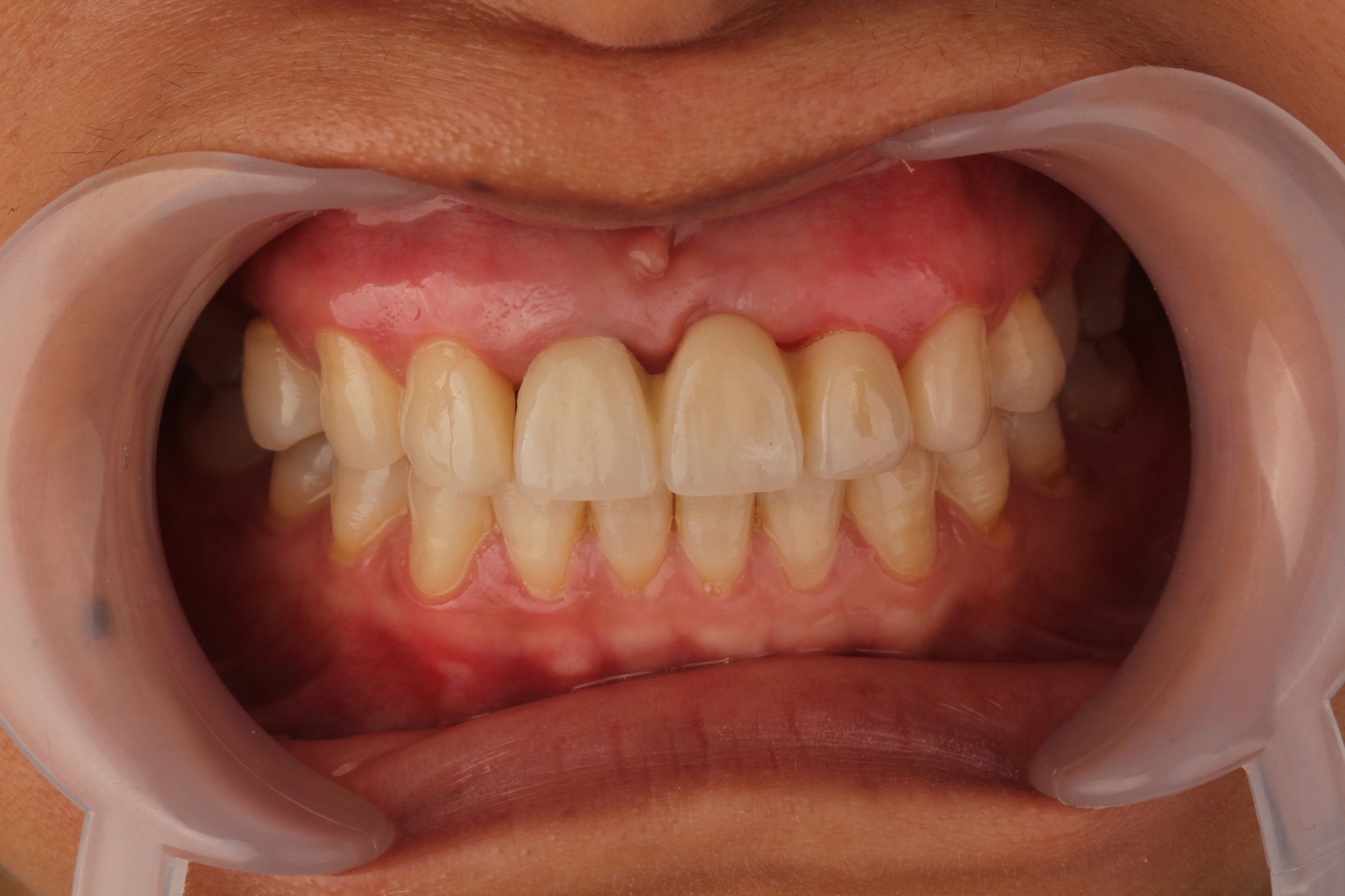 图4-83 上下牙弓牙尖咬合时左侧唇颊面观-口腔颌面及颈部临床解剖学-医学
